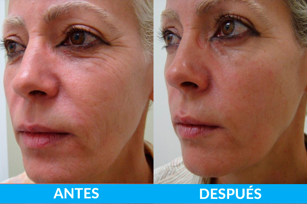 tratamiento arrugas antes y después