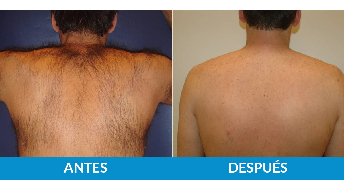 tratamiento antes y después fotodepilación médica espalda