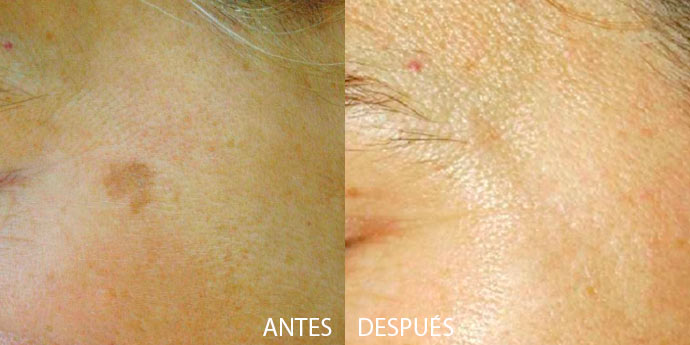 antes y después peeling facial Madrid
