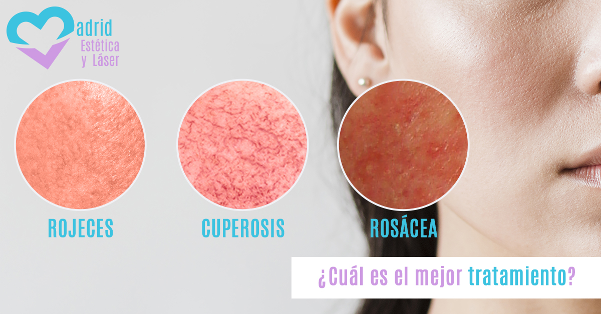 Tratamiento láser cuperosis y rosácea Estética y Laser Madrid