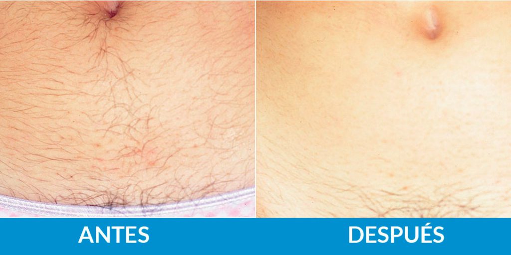 antes-despues-fotodepilacion