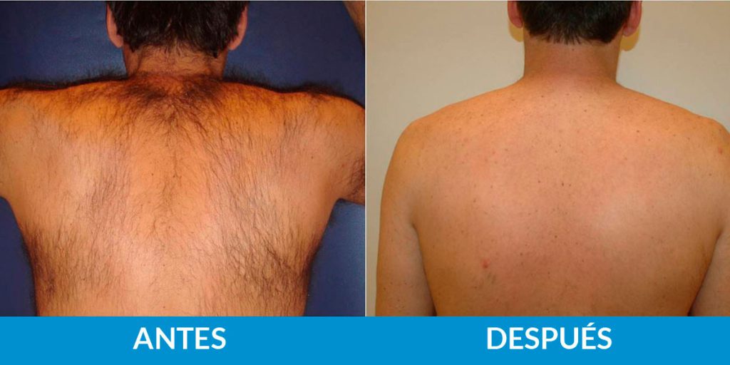 antes-despues-fotodepilacion2