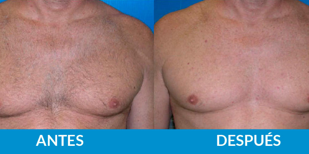 antes-despues-fotodepilacion3