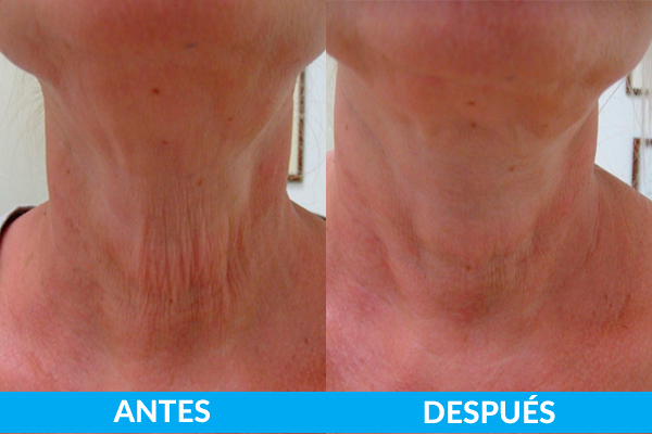 tratamiento-antes-y-despues