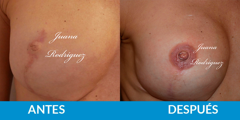 Antes y después Tatuaje Areola y Pezón 2