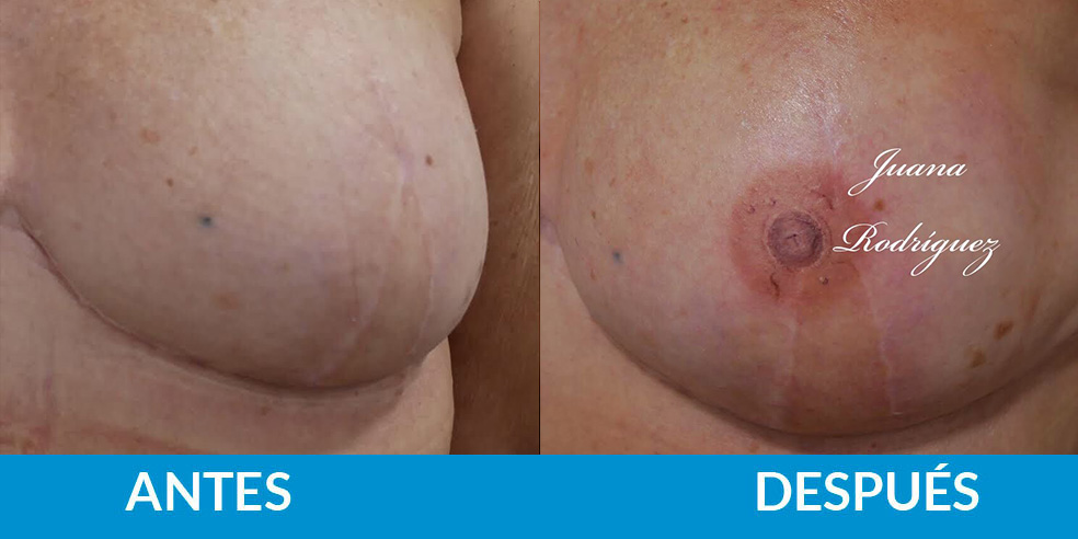 Tatuaje oncológico
