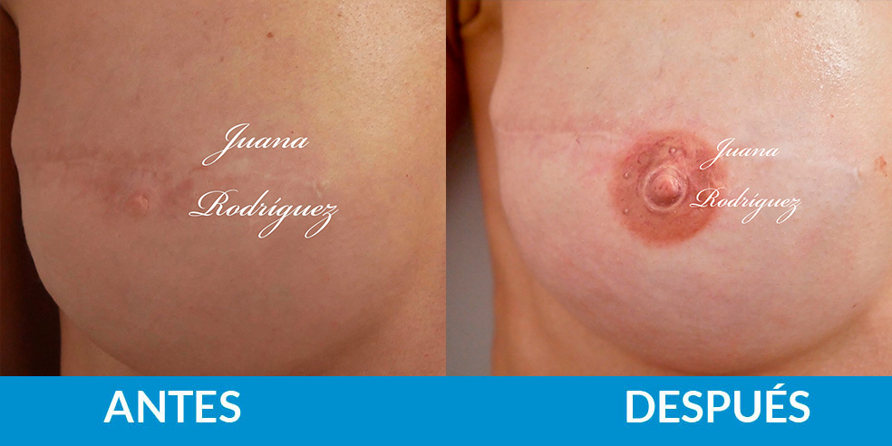 Antes y después tatuaje areola y pezón
