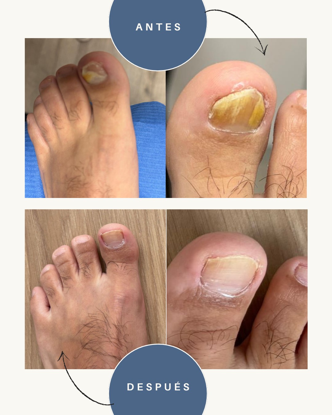 Onicomicosis resultados
